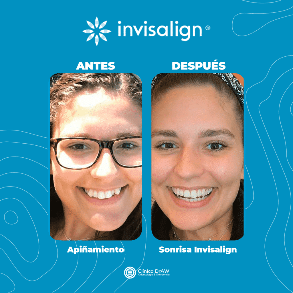Invisalign Antes y Después