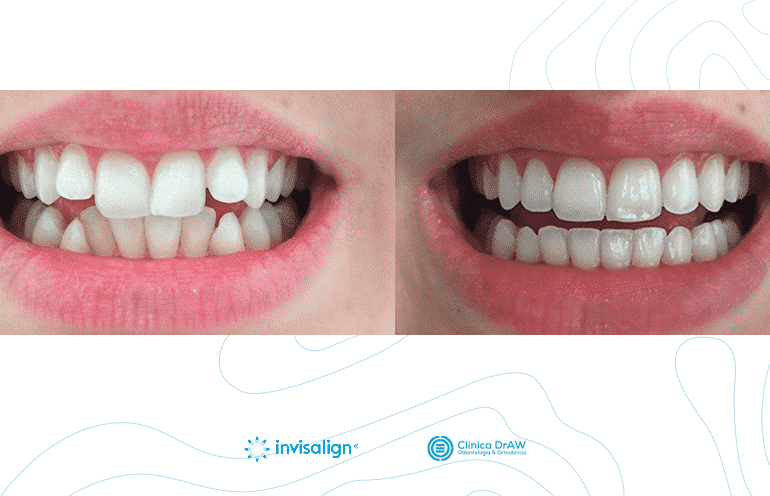 Alineadores Invisalign