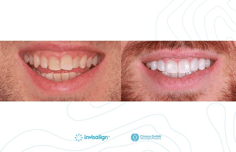 Invisalign Dientes Apiñados