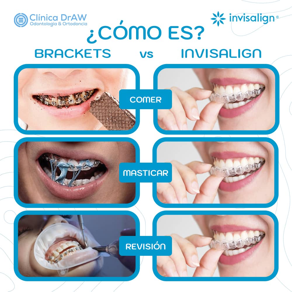 Alineadores Dentales vs brackets