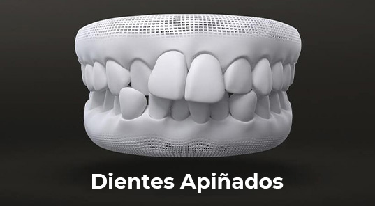 dientes-apiñados