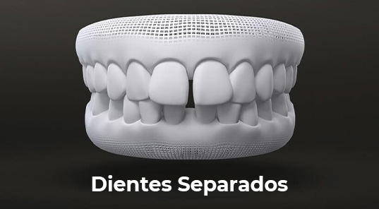 dientes-chuecos