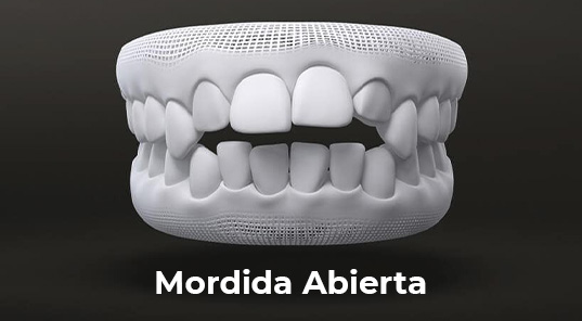 mordida abierta