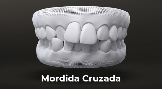 mordida cruzada