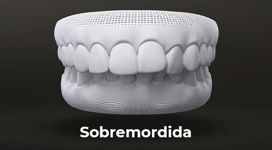 sobremordida